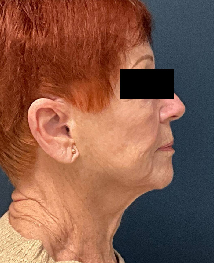 Facelift case #7712
