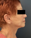 Facelift case #7712