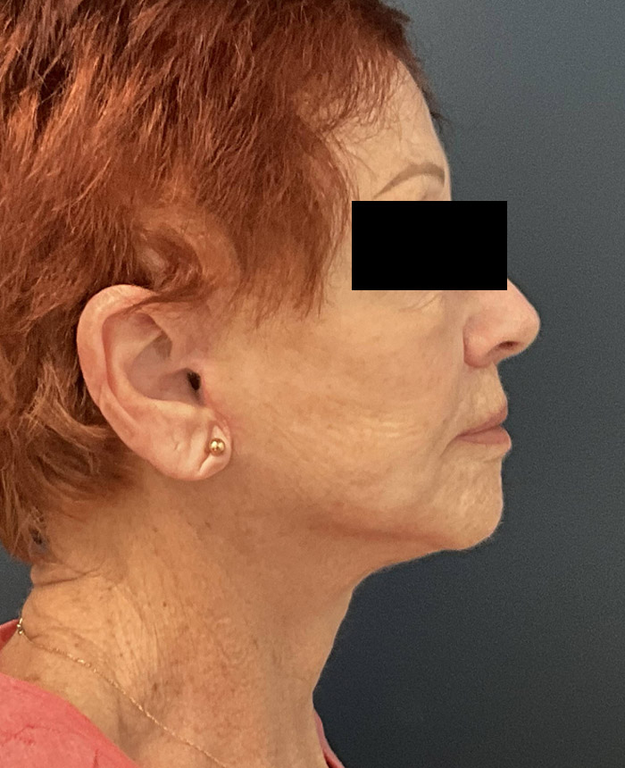 Facelift case #7712