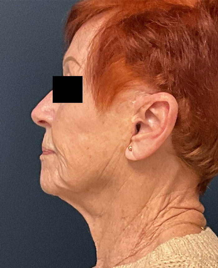 Facelift case #7712