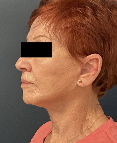 Facelift case #7712
