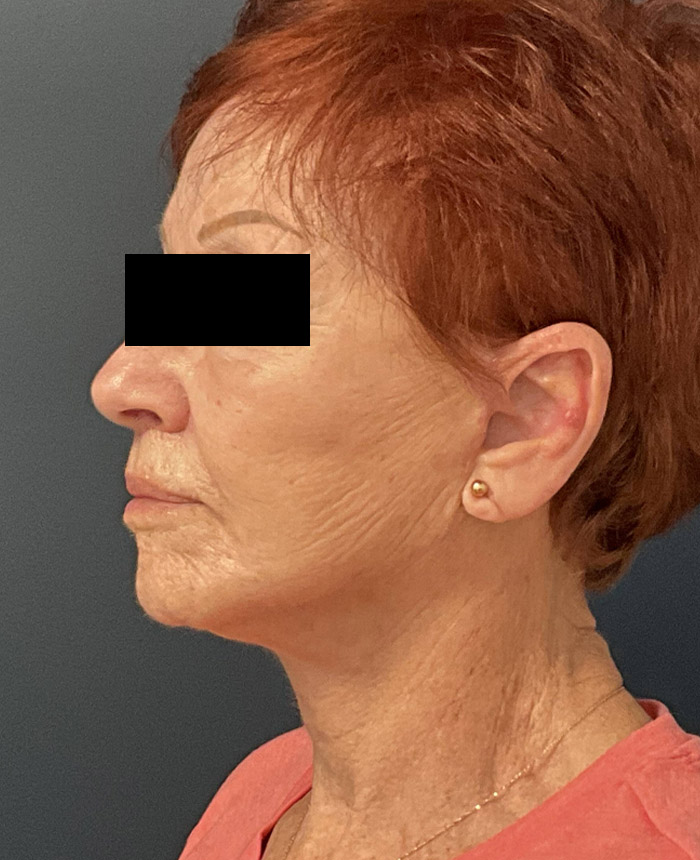 Facelift case #7712