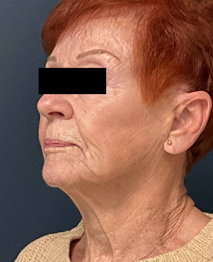 Facelift case #7712
