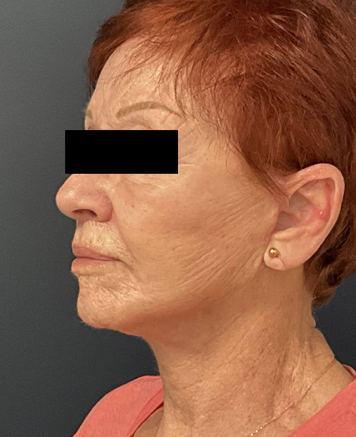 Facelift case #7712