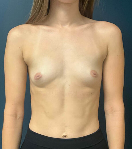 Breast Augmentation case #8506