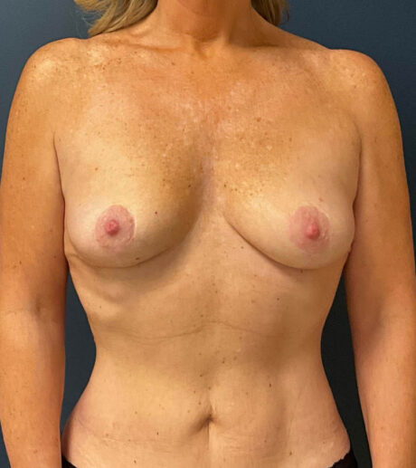 Breast Augmentation case #8389