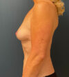 Breast Augmentation case #8389