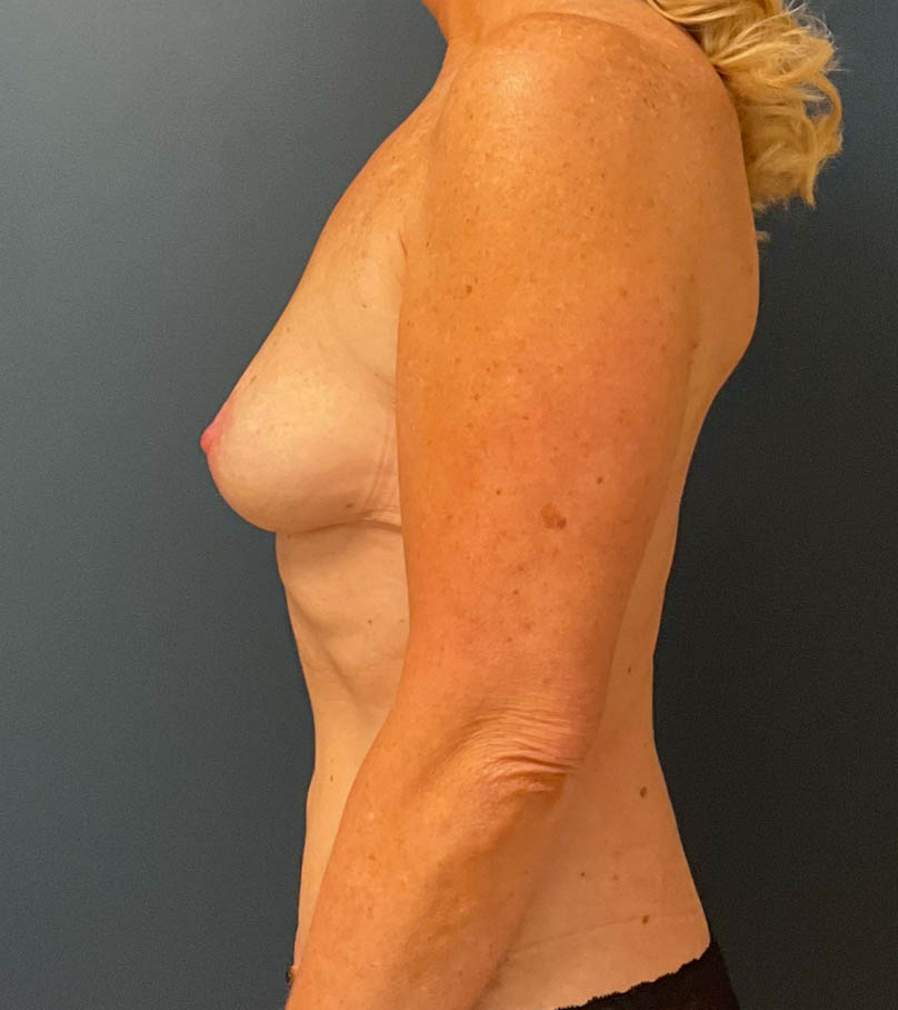 Breast Augmentation case #8389