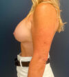 Breast Augmentation case #8389