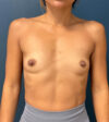 Breast Augmentation case #8517