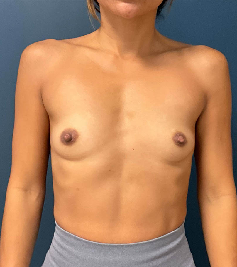 Breast Augmentation case #8517