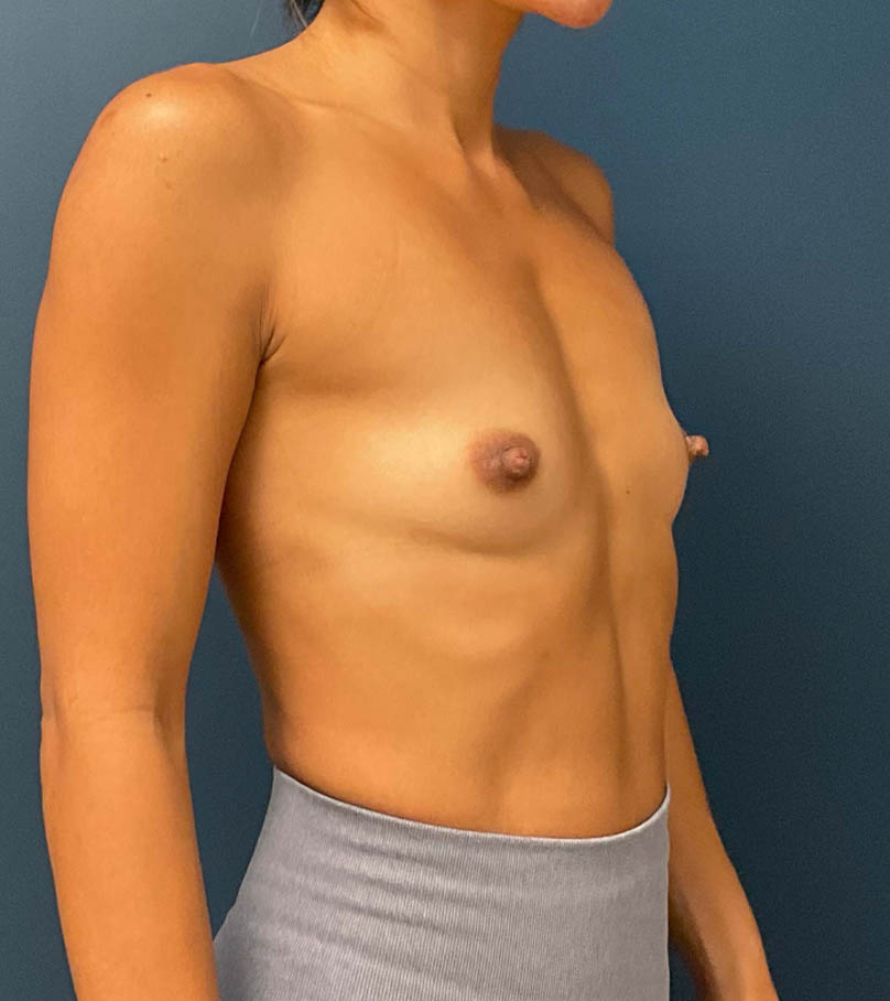 Breast Augmentation case #8517