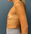 Breast Augmentation case #8517