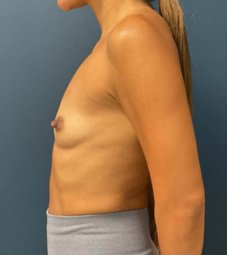 Breast Augmentation case #8517