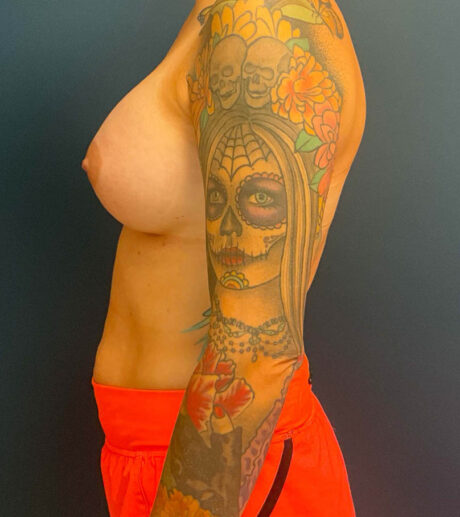 Breast Augmentation case #8400