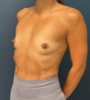 Breast Augmentation case #8517