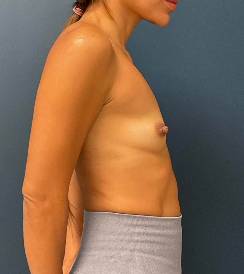 Breast Augmentation case #8517