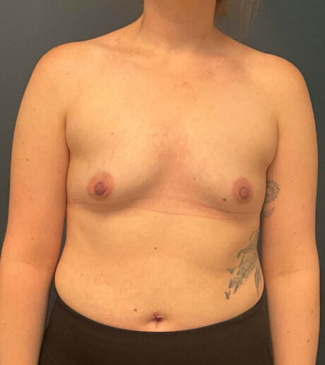 Breast Augmentation case #9730