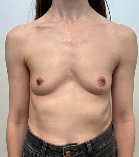 Breast Augmentation case #9799