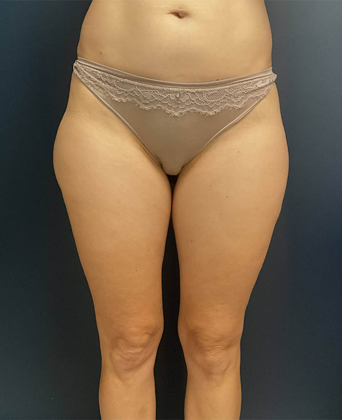 Liposuction case #9697