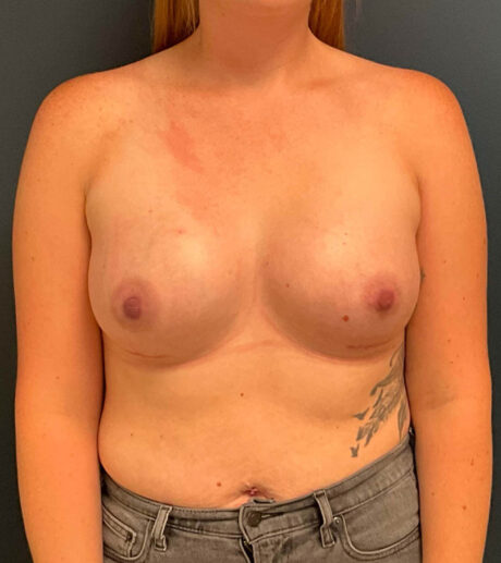 Breast Augmentation case #9730
