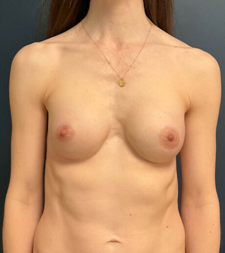Breast Augmentation case #9799