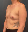 Breast Augmentation case #9730