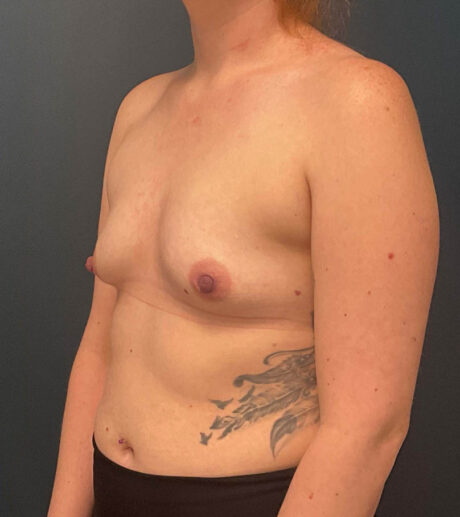 Breast Augmentation case #9730