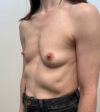 Breast Augmentation case #9799