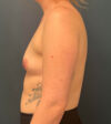 Breast Augmentation case #9730