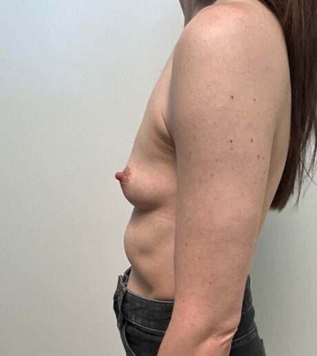Breast Augmentation case #9799