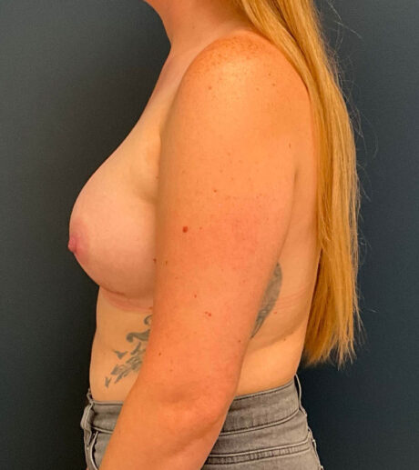 Breast Augmentation case #9730