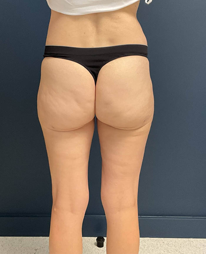 Liposuction case #9697