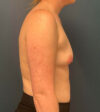 Breast Augmentation case #9730