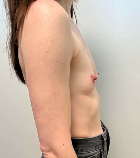 Breast Augmentation case #9799