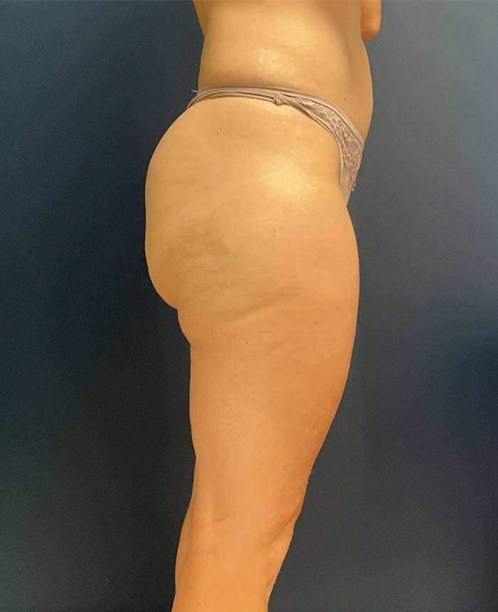 Liposuction case #9697