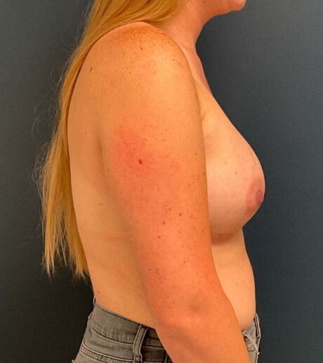 Breast Augmentation case #9730