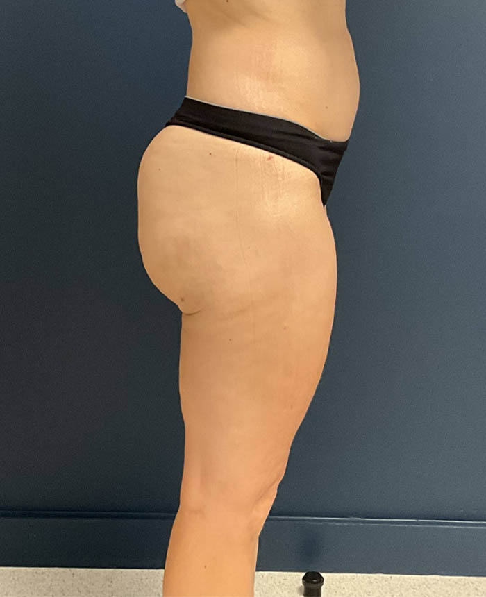 Liposuction case #9697