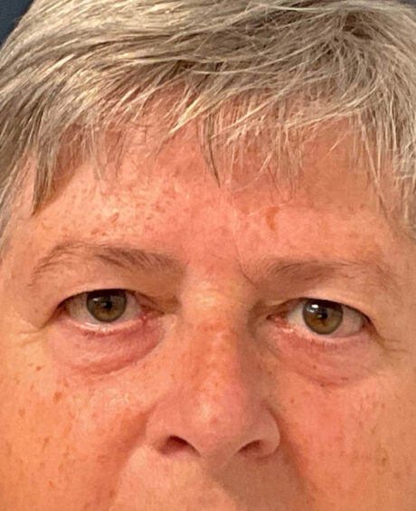 Eyelid Surgery case #9708