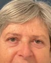 Eyelid Surgery case #9708
