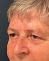 Eyelid Surgery case #9708
