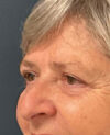 Eyelid Surgery case #9708