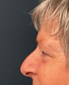 Eyelid Surgery case #9708