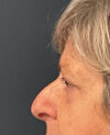 Eyelid Surgery case #9708