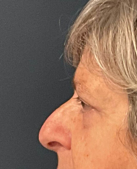 Eyelid Surgery case #9708