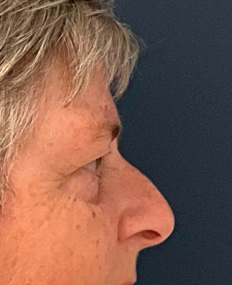 Eyelid Surgery case #9708