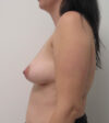Breast Augmentation case #9810