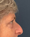 Eyelid Surgery case #9708