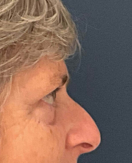 Eyelid Surgery case #9708