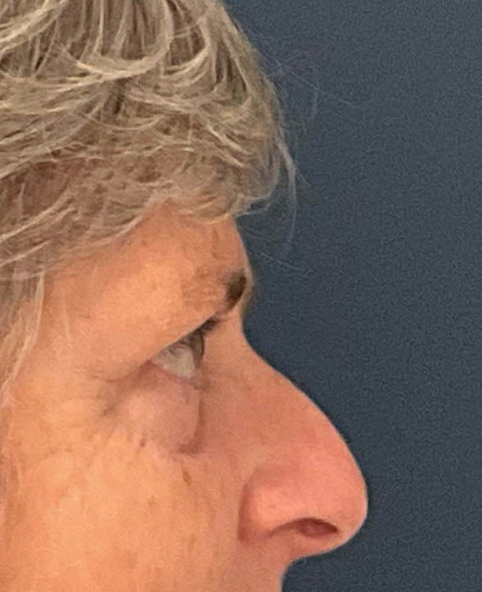 Eyelid Surgery case #9708